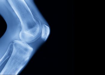 Tech Employees Are Getting Leg-Lengthening Surgery to Grow 3 Inches